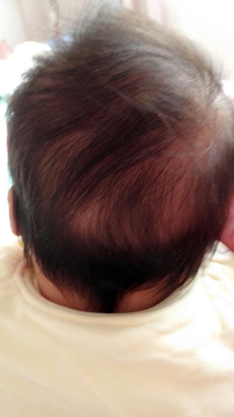 宝宝两个多月了头睡偏了后脑勺左边偏高右边偏低,脸也大小不一(左边大