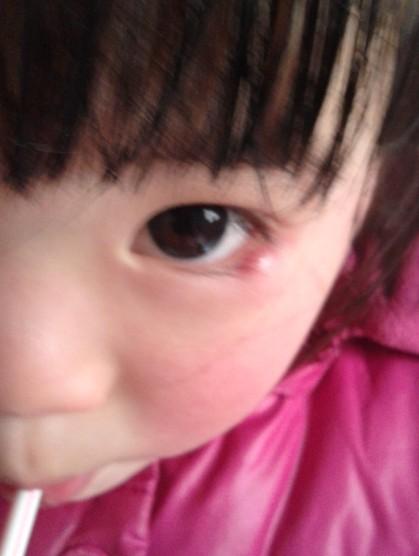 2周岁宝宝下眼皮外长了一个红痘,半个多月了,无脓无白点,怎么回事,附