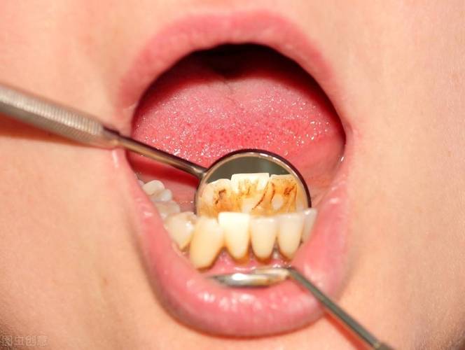 刷牙出血是什么原因第一次洗牙好尴尬