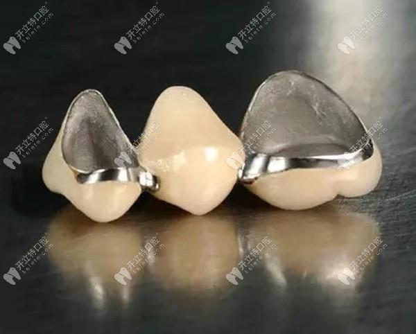 钴铬烤瓷牙的价格 钴铬烤瓷牙的价格