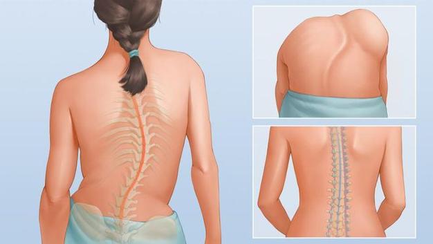 脊柱侧弯可导致脊柱变形,肩背部不平,胸廓畸形,骨盆倾斜,长短腿,姿势