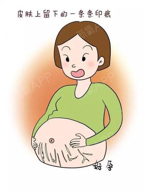 妊娠纹 发生几率大概在6-8成之间 原因是:真皮层胶原蛋白与弹力蛋白