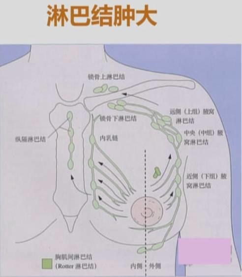 乳腺癌的癌细胞侵及淋巴管,可经胸大肌外侧缘的淋巴管侵犯到同侧的
