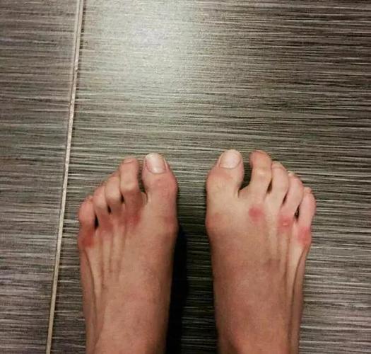有一位在练习芭蕾舞的舞者,在朋友圈里,发了自己的脚的图片95作为