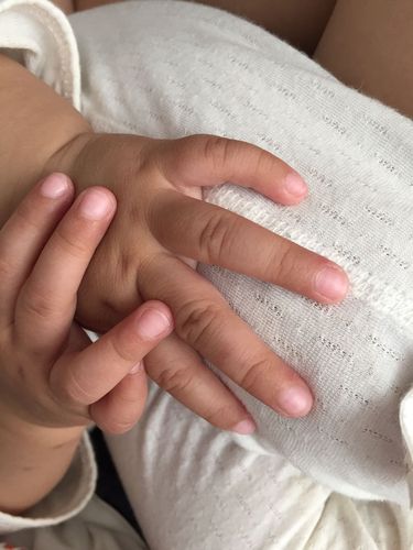 宝宝手指甲上有白横纹
