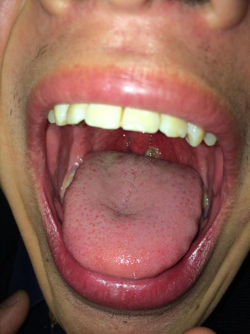 喉咙中间有个白色空泡,是什么情况?