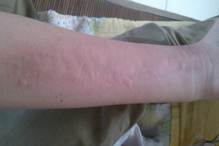 日光性荨麻疹手臂皮损图
