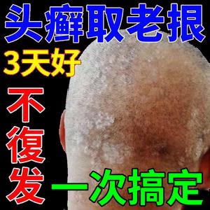 头皮癣银屑病专用药膏真菌感染去头癣藓治疗头部牛皮癣外用特效药