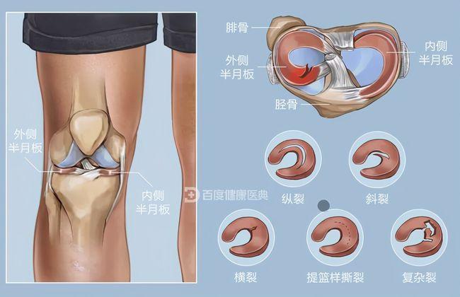 半月板是位于膝关节内,大腿骨(股骨)和小腿骨(胫骨)之间的纤维软骨板