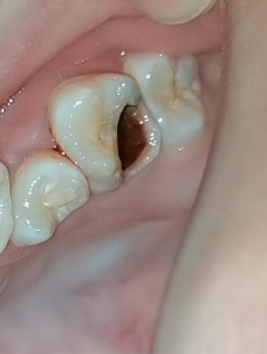 我的这颗牙蛀了好多年了好大的洞这是深龋吗