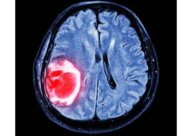 什么是脑肿瘤是什么引起的脑肿瘤可以治愈吗上