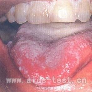 艾滋病初期症状之白色念珠菌感染图片