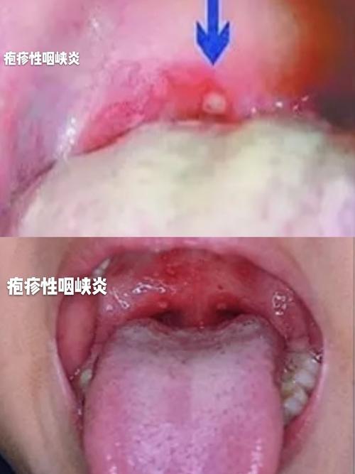 【沣西新城马王街道中心幼儿园】温馨提示——预防疱疹性咽峡炎