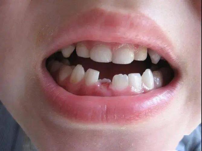 1,如果是由于门牙两旁的牙齿未萌出,门牙侧移而出现门牙间缝隙,则该