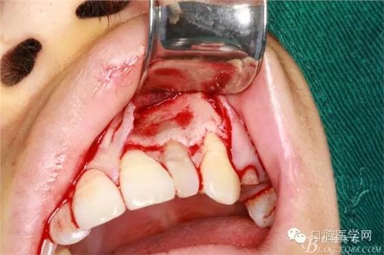 一例左上侧切牙根尖切除术