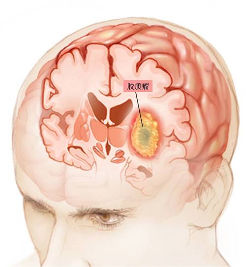 p>脑胶质瘤是由于大脑和脊髓胶质细胞癌变所产生的,最常见的原发性