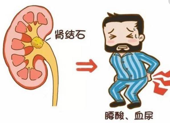 广州结石医院:肾结石的三大症状表现
