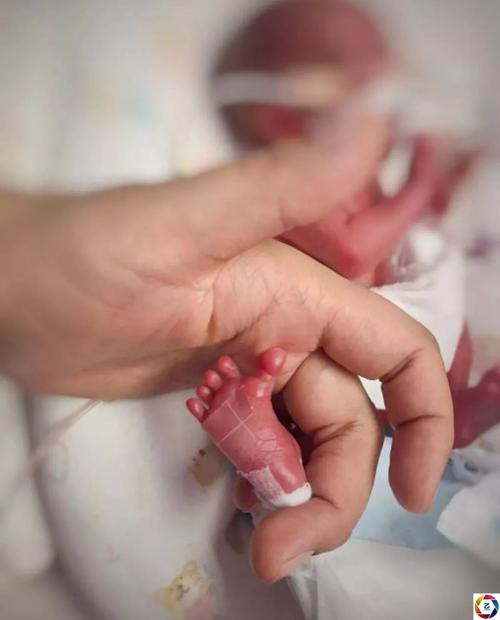 极早产婴儿出生仅29厘米体重580克在保温箱住140天后出院