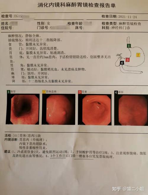 亲历广州中山六院肠胃镜检查获提胃息肉一块