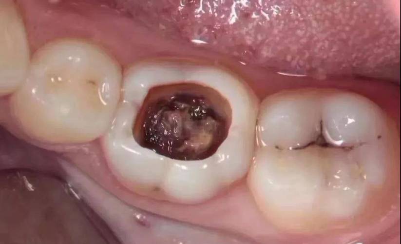 临床病症具体表现为龋坏的牙齿出现入口大小不一但是很深的龋洞,虽然