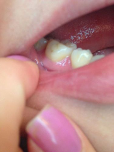 乳牙根尖周炎治疗后牙龈上有白点