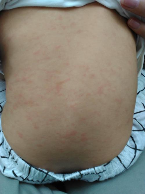 5度,这两天退烧后前胸和后背起红色皮疹,请问这是幼儿急疹吗?