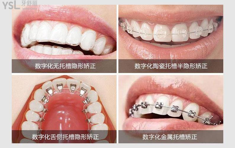 在广州做牙齿矫正要花多少钱这些矫正牙齿效果好还实惠的口腔医院必选