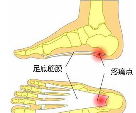 多表现为足跟部的疼痛与不适,通常见于晨起或过度用脚行走后.