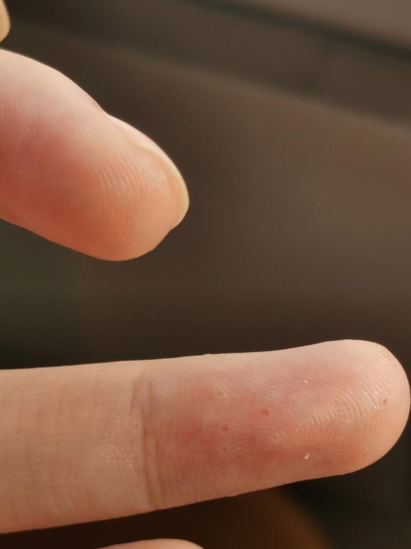 手指湿疹 手指指腹长了好多小水泡,3月16开始长的,到现在4月27了还没