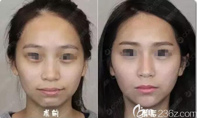 南京康美分享注射几支玻尿酸1支瘦脸针改变咬肌鼻子下巴轻轻松松从