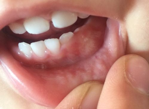 宝宝出牙期,牙龈鼓起两个对称大包 有相同情况的吗?