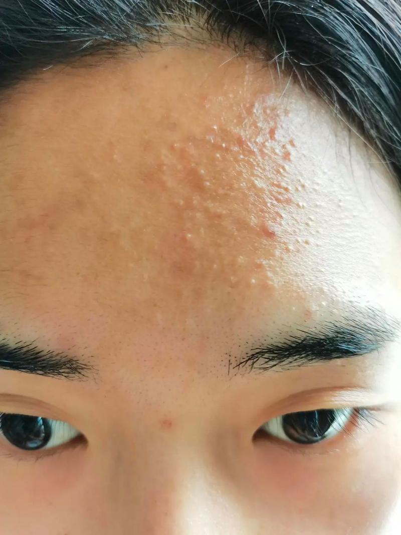 额头密密麻麻的小颗粒可能是青春痘或粉刺.