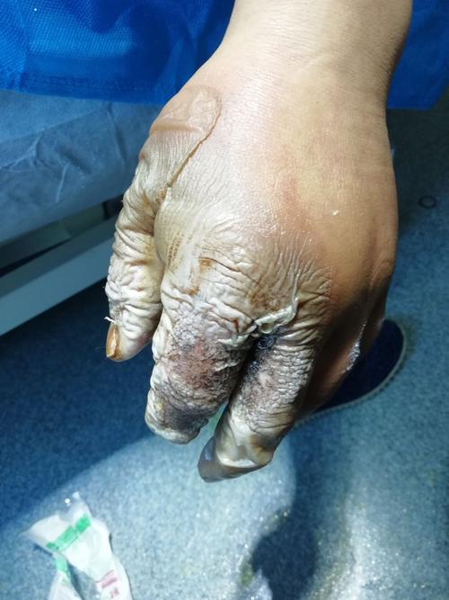 洛阳市第十人民医院烧伤与创面修复科一直在为患者的需要而努力