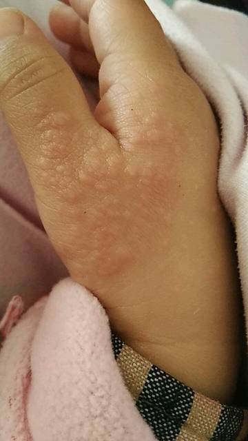 2岁宝宝手上长湿疹怎么办