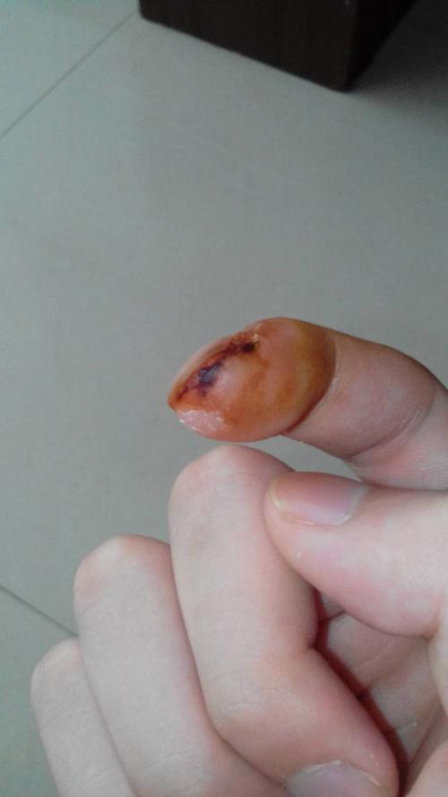 关于手指被刀割伤的问题,我25天前手指被刀割伤了,然后我爸倒了云南