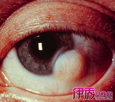 【图】眼部囊肿图片曝光 为你详解眼部囊肿瘤的4大临床表现