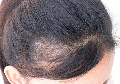 女性掉头发厉害是什么原因 - 脱发人tuofaren