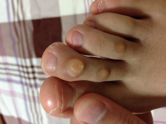 张金山 医师 脚趾上有个小疙瘩,几年了不疼不痒也不长大,怎样去除