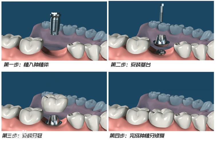 口腔修复工艺学专业是口腔临床工作中的重要技术专业,旨在培养适应