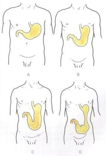a:鱼钩型胃 b:牛角型胃 c:瀑布型胃