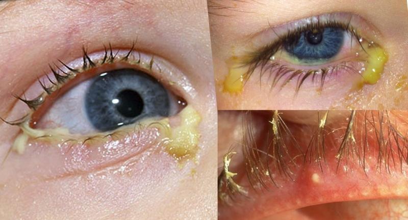 这些东西俗称「眼屎」,又叫「眼眵」或「眵目糊」,是眼睛里的分泌