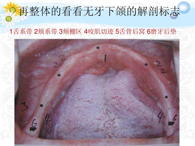 再整体的看看无牙下颌的解剖标志 1舌系带 2颊系带 3颊棚区 4咬肌切迹