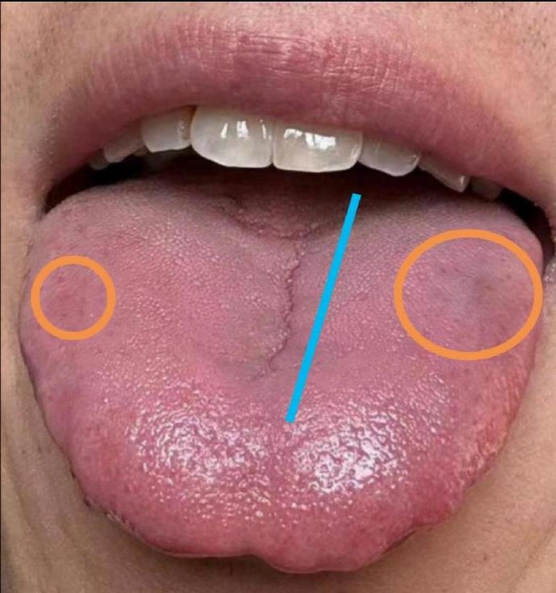 舌头中间有裂纹,代表脾胃虚弱.