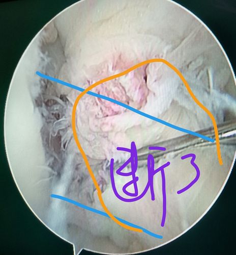 湘雅医院骨科近年来开展膝关节前交叉韧带损伤重建手术,至今已积累了