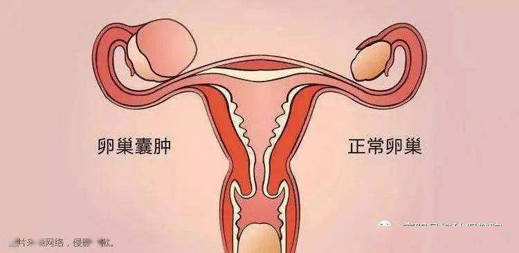 高阳妇幼61女性健康关于卵巢囊肿