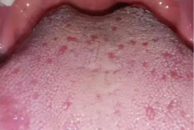 菌状乳头炎菌状乳头主要分布在舌体前缘,分布于舌背丝状乳头之间,稍