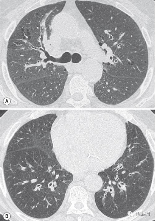 格艾选读丨慢性阻塞性肺疾病(copd):气道炎性改变,肺气肿_支气管