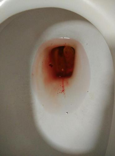 每次上完厕所都便血,还有血块