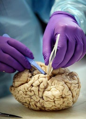 神经病理学家演示人脑解剖全过程