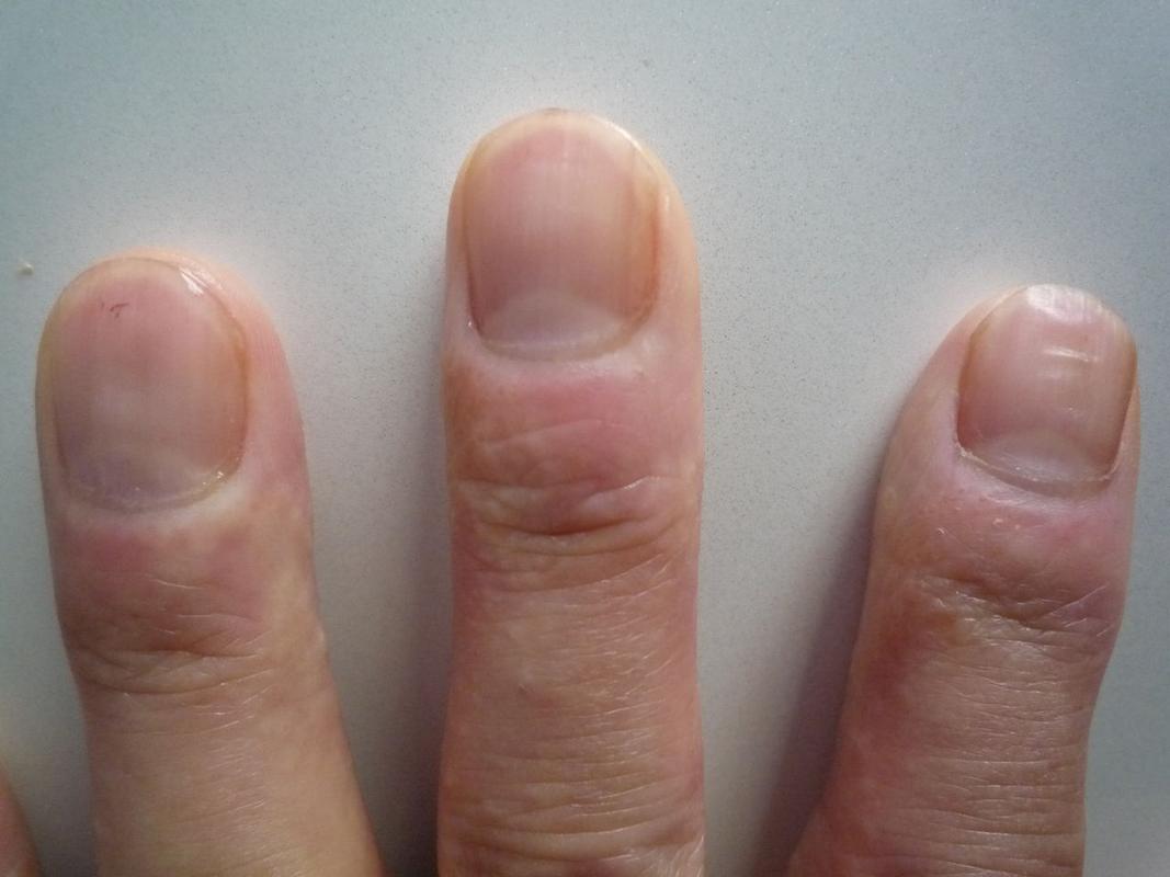 指甲上有横纹是什么病